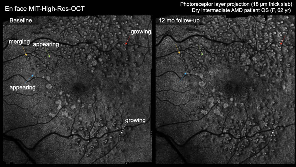 Longitudinal tracking of human retina with age-related macular degeneration